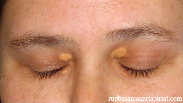 Ketahui Penyebab dan Cara Mengatasi Xanthelasma