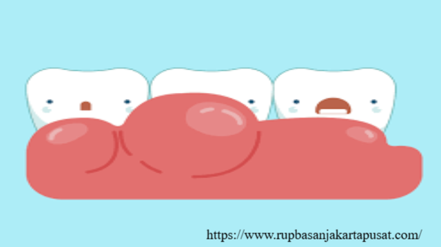 Gusi Bengkak Pertanda Masalah Kesehatan Mulut Serius